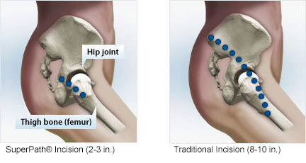 SuperPath® Hip Replacement